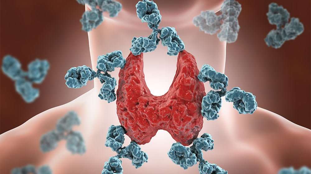 3D Image illustrate Hashimoto's disease - one of 1…eases That Disrupt Your Weight Control | Feature | 10 Autoimmune Diseases That Disrupt Your Weight Control